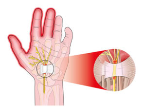 transverse carpal ligament compressed median nerve